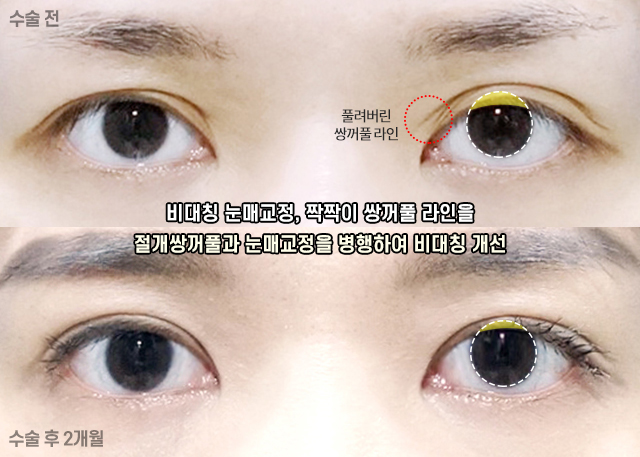 Case Examples of Correcting Uneven Eyes Through Ptosis Correction image 9