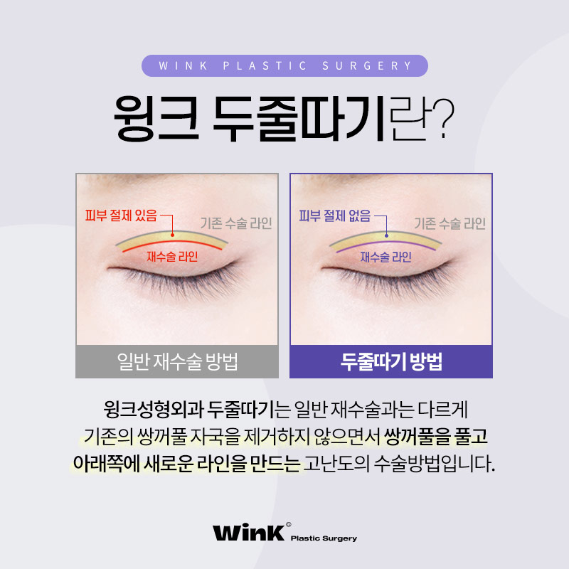 두껍고 높은 소세지눈? 윙크성형외과 두줄따기로 라인낮추기! 관련 이미지 3
