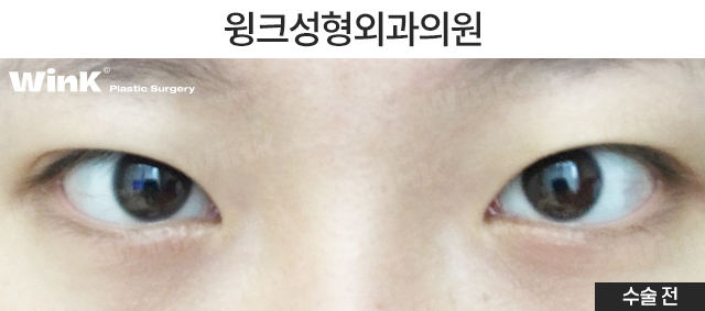 If You’re Looking Into Revision Double Eyelid Surgery, Visit Wink Plastic Surgery for Beauty and Function! image 2