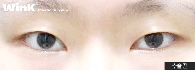 If you want to create the double eyelid line you want without being limited by your eye shape, Wink Incision Double Eyelid Surgery! image 8