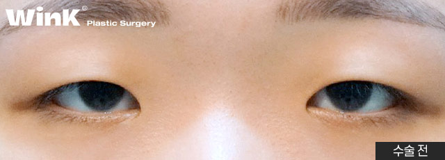 Is Fast Recovery Only Possible with Non-Incisional Surgery? At Wink Plastic Surgery, Incisional Double Eyelid Surgery Can Also Return You to Daily Life Quickly! image 8