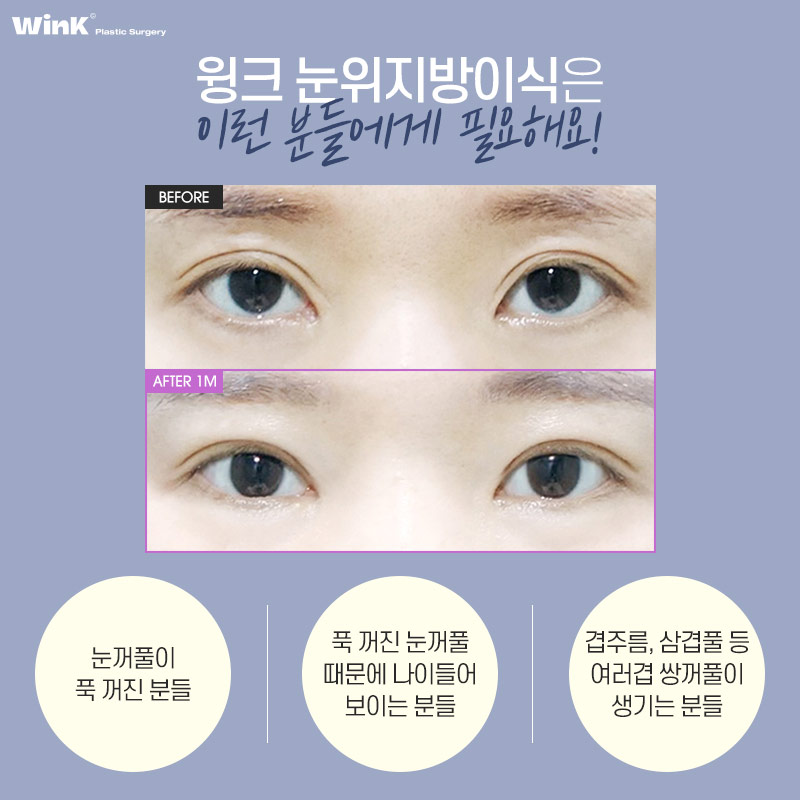 Let’s Restore Volume to Sunken Eyes with Wink Plastic Surgery’s Upper Eyelid Fat Grafting image 5