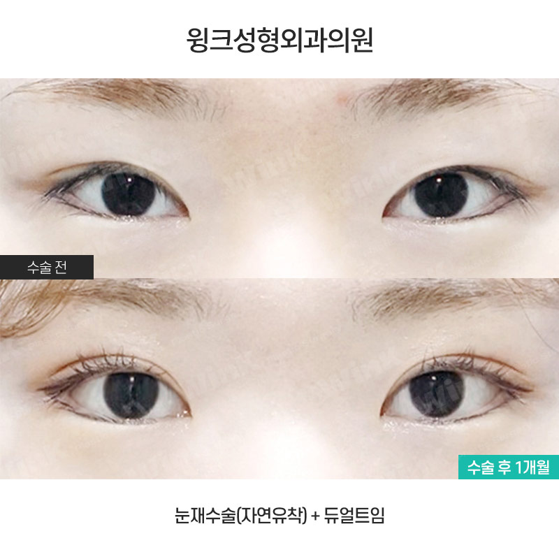 뒷밑트임으로 눈의 숨겨진 공간을 찾자! 윙크 듀얼트임 관련 이미지 1