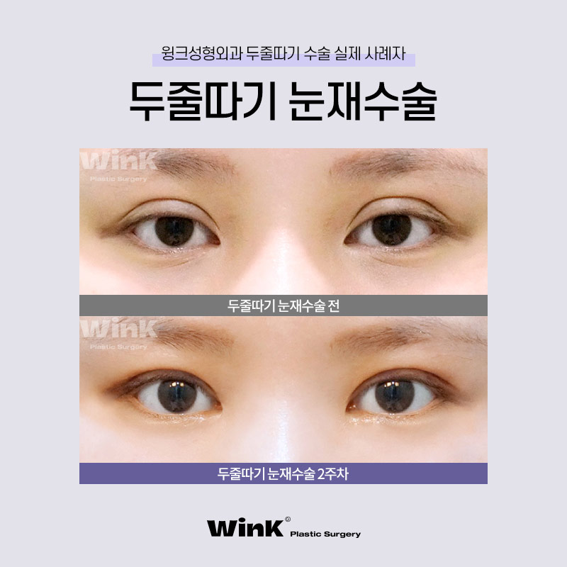 두껍고 높은 소세지눈? 윙크성형외과 두줄따기로 라인낮추기! 관련 이미지 6