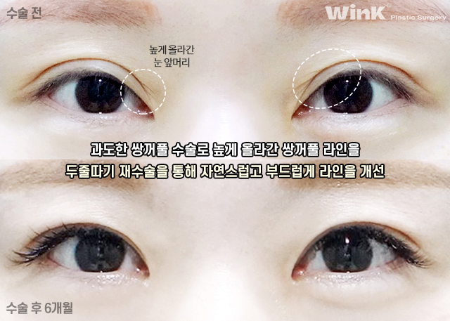 Turning a Thick Outer-Line Double Eyelid into a Natural Inline Through Double-Fold Revision image 4