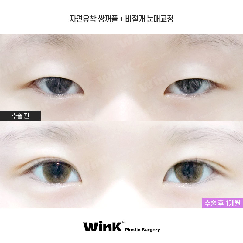 자연스럽고 잘 풀리지 않는 윙크 심플커브 자연유착 관련 이미지 1