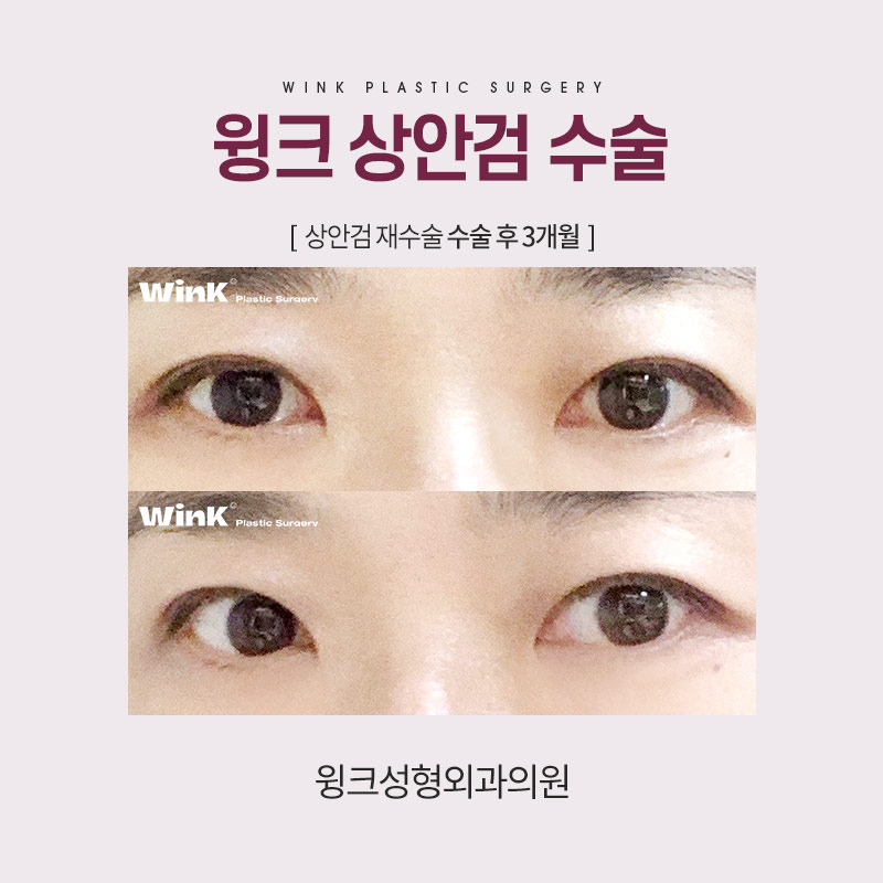 중년눈성형 상안검수술을 알아보자. 관련 이미지 8