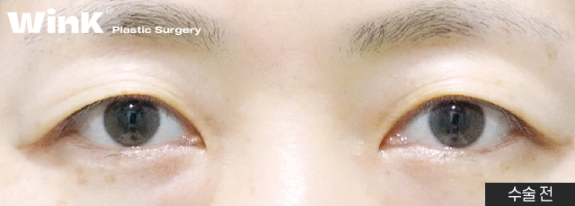 Improve Droopy Eyes with Wink Middle-Age Eyelid Surgery! image 3