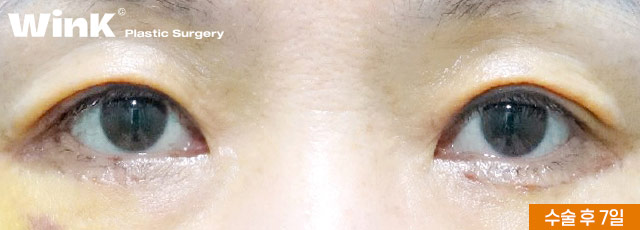 Sagging Eyelids That Have Lost Elasticity: A Youthful Eye Look with Upper Blepharoplasty at Wink Plastic Surgery image 6