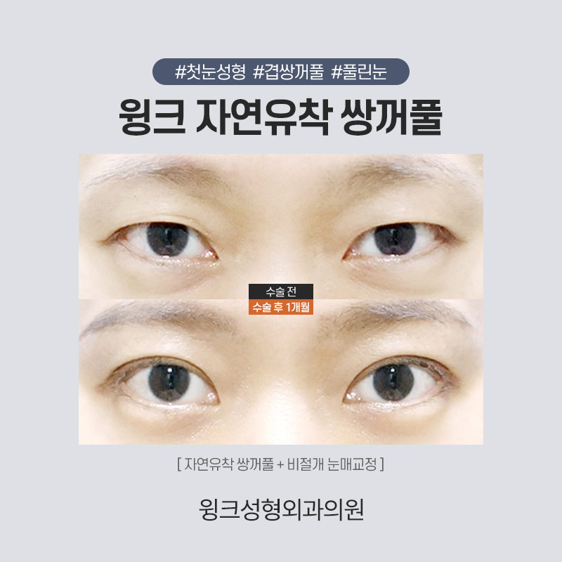 자연유착 쌍꺼풀수술로 겹주름을 해결하려면? 관련 이미지 6