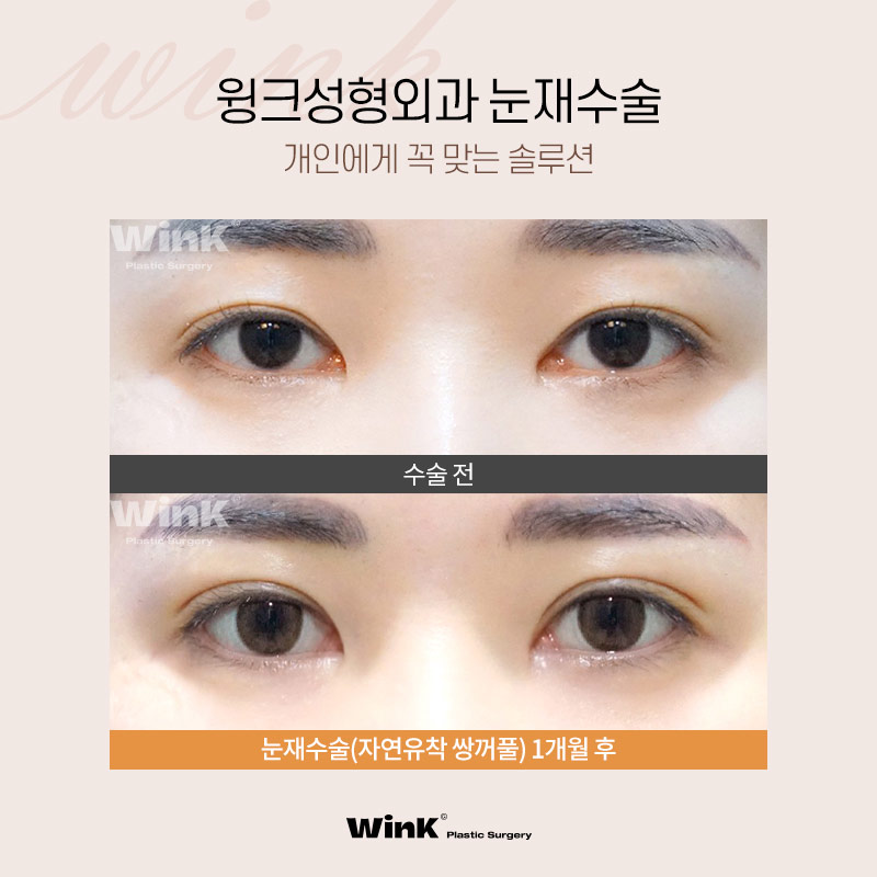 1차 수술 실패 원인 파악이 중요한 눈재수술, 윙크성형외과에서 정확하게 파악해 드려요! 관련 이미지 6