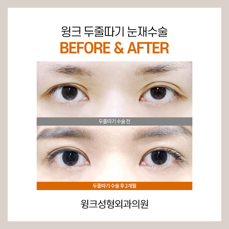 Let’s take a look at the differences before and after line lowering. image 3
