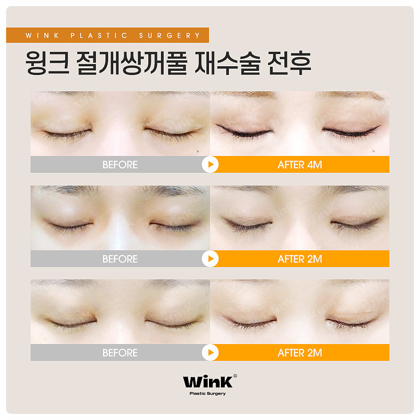 Double Eyelid Surgery Sausage Eyes, Double Eyelid Surgery Scars, Wink Plastic Surgery Double Eyelid Line Lowering, Sinsa Revision Eye Surgery Before and After image 7