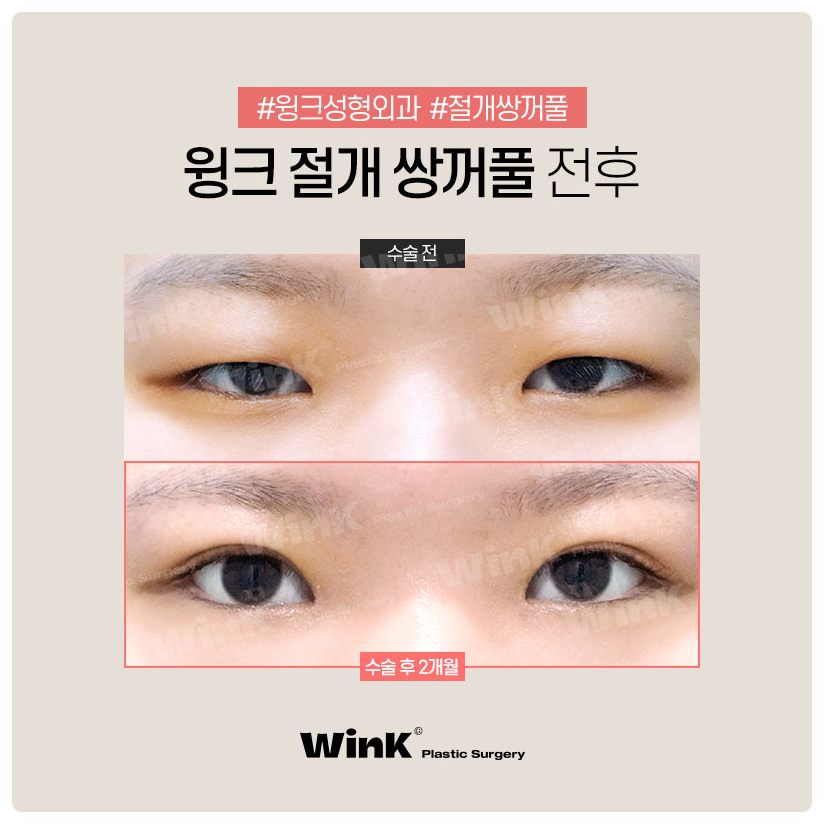 쌍꺼풀수술잘하는곳 쌍꺼풀만들기  신사쌍꺼풀수술 은 윙크성형외과 관련 이미지 8