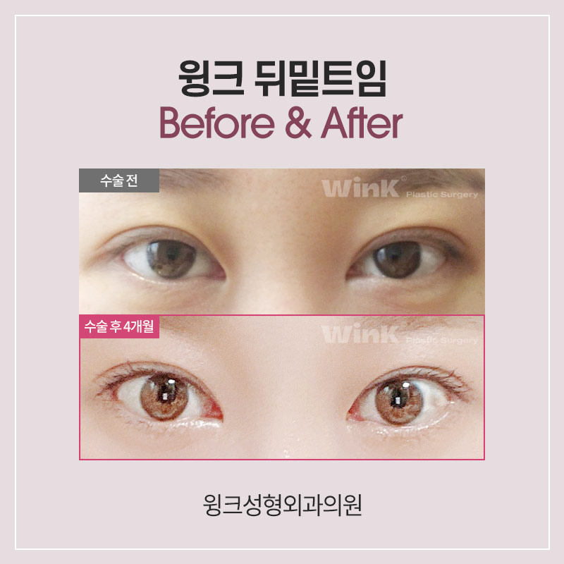 Shall We Learn About Canthoplasty and Dual Canthoplasty? image 5