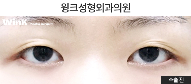 Let’s Learn About Incisional Double Eyelid Surgery. image 5