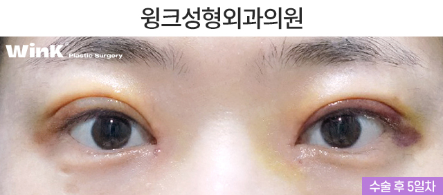 윗트임은 어떤 경우에 하면 좋을까요? 관련 이미지 3