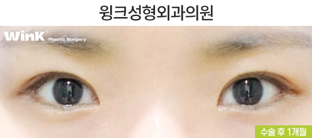 How Should Double Eyelid Surgery Be Performed for Small, Narrow Eyes? image 3