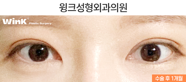 소세지눈 재수술, 두줄따기로 라인 낮추기 관련 이미지 4