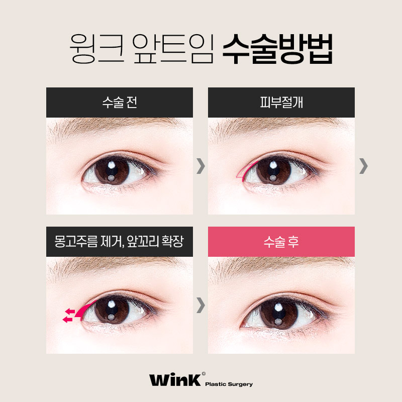 The Impact of Epicanthal Folds on Double Eyelid Surgery! Epicanthoplasty, Epicanthoplasty Cost, Sinsa Epicanthoplasty image 6