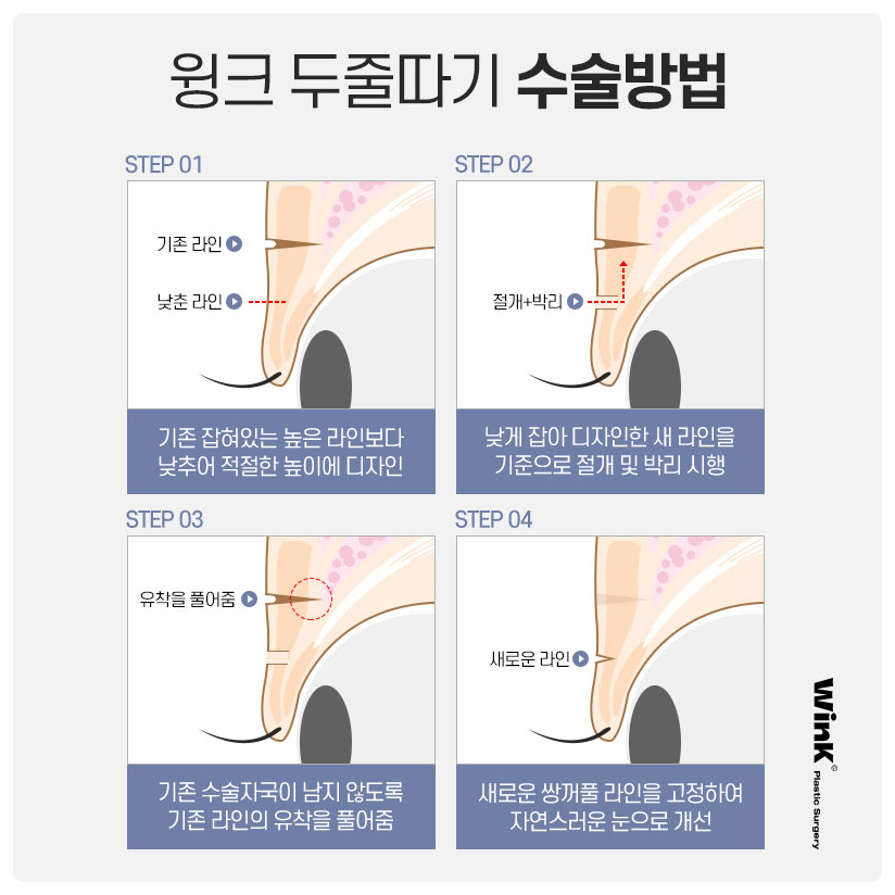 Revision Surgery for Sausage-Like Double Eyelids: Lowering the Double-Eyelid Line, Wink Plastic Surgery Sausage-Eye Revision Review image 4