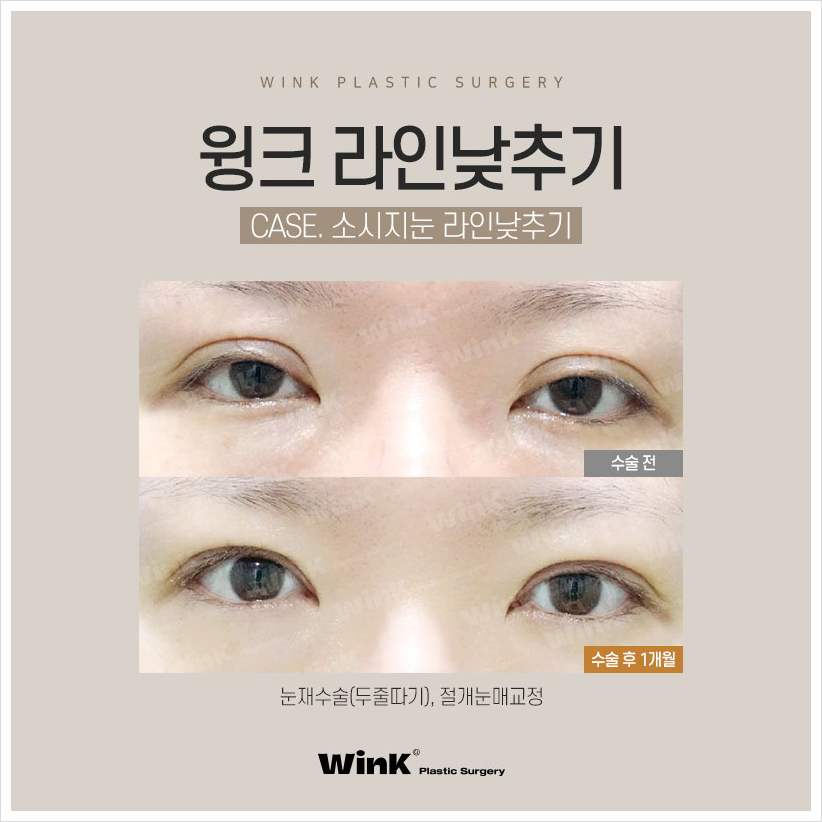 신사두줄따기 윙크성형외과 쌍꺼풀풀기 쌍꺼풀라인낮추기 소세지쌍꺼풀재수술 관련 이미지 8