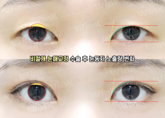 Wink Plastic Surgery’s Non-Incisional Ptosis Correction for Clearer Eyes Without an Incision! image 10