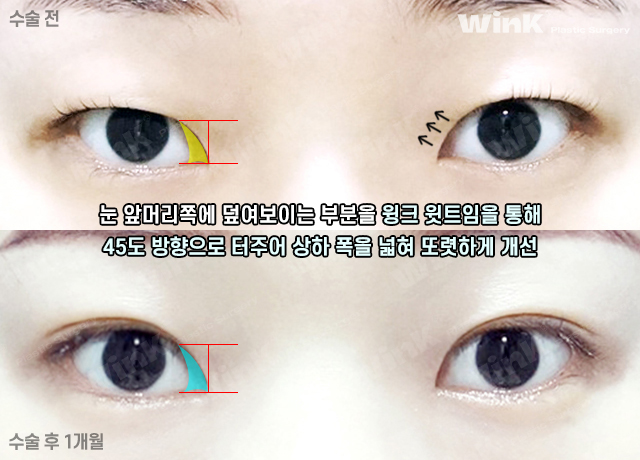 Let’s Take a Look at the Changes and Effects Before and After Upper Epicanthoplasty image 4