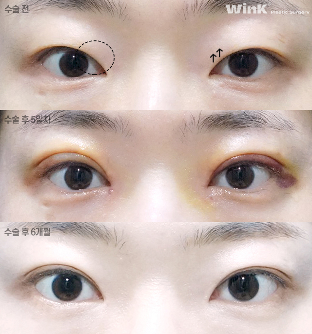 윗트임은 어떤 경우에 하면 좋을까요? 관련 이미지 4