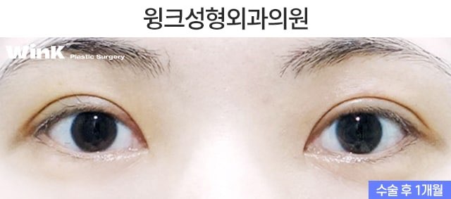 겹쌍꺼풀 해결 방법에 대해 알아보겠습니다. 관련 이미지 3