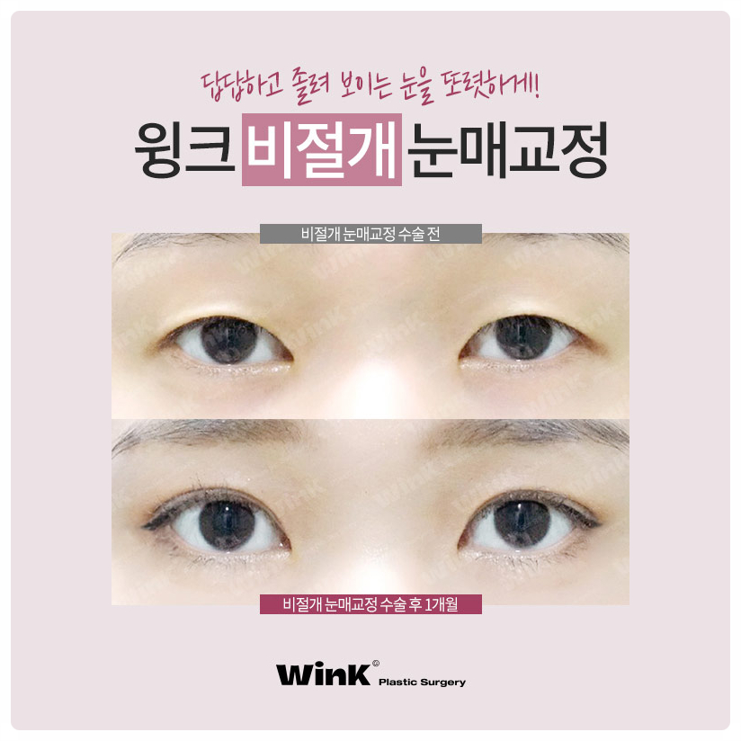 If you are looking into ptosis correction and double eyelid surgery before and after ptosis correction surgery at Sinsa Station, Wink Plastic Surgery image 5