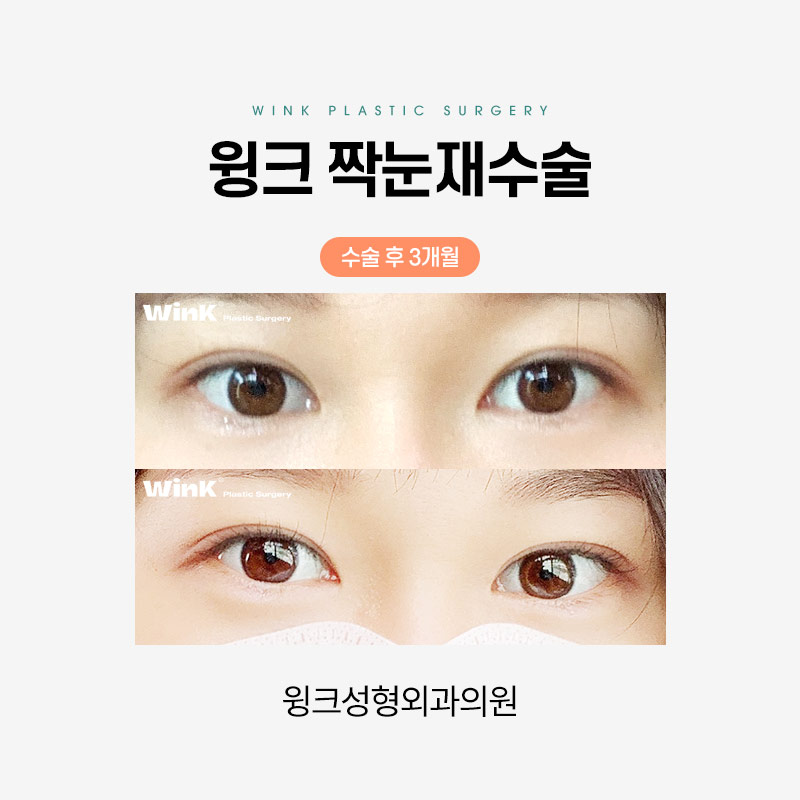 짝눈 쌍꺼풀 재수술에 관해 알아보겠습니다. 관련 이미지 8