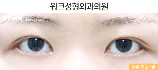 Let’s Learn About Incisional Double Eyelid Surgery. image 6