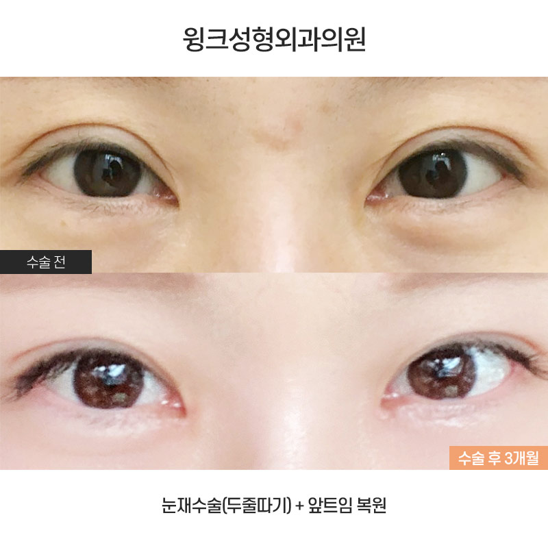 Can Medial Epicanthoplasty Revision and Incisional Double Eyelid Revision Be Done at the Same Time? image 1