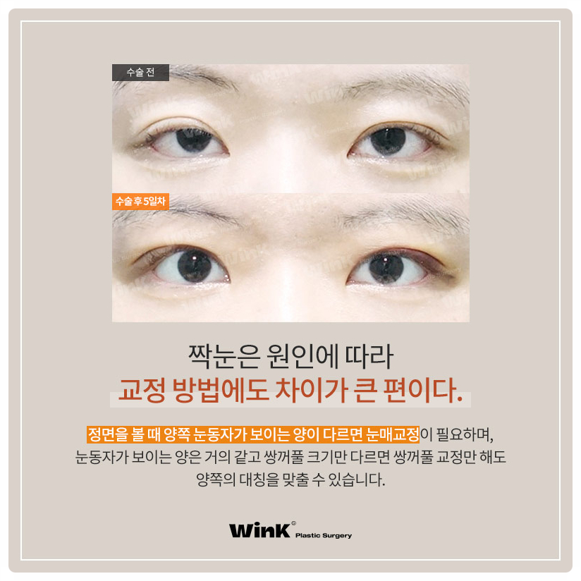짝눈눈매교정술 잘하는곳? 비대칭짝눈교정 짝눈쌍수 잘하는 윙크성형외과 눈매교정짝눈! 관련 이미지 5