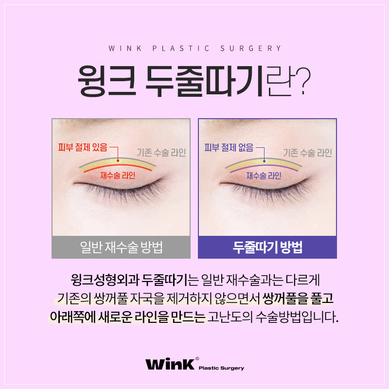 쌍꺼풀비후증(소세지눈), 윙크성형외과 두줄따기로 자연스럽게! 관련 이미지 2