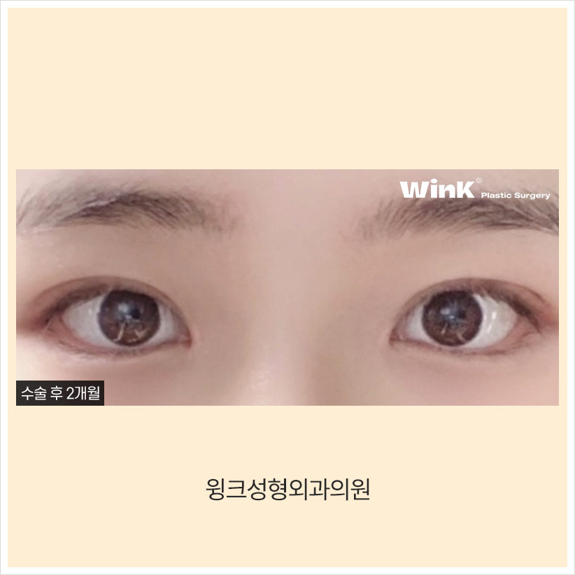 인라인쌍꺼풀 윙크성형외과 자연유착쌍꺼풀후기 자연유착법 관련 이미지 6