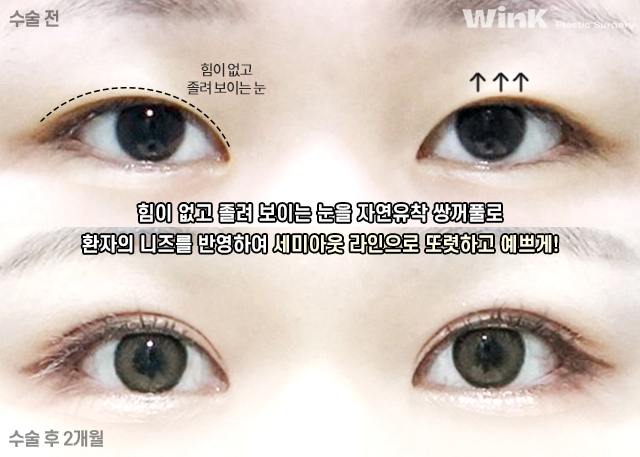 자연유착 쌍꺼풀에 대해 알아보겠습니다. 관련 이미지 4