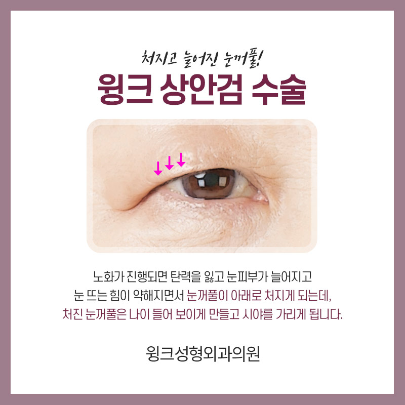 중년눈성형 상안검수술을 알아보자. 관련 이미지 2