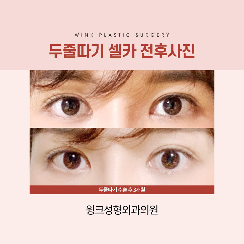 A sausage line can be improved with double-line blepharoplasty revision surgery. image 7