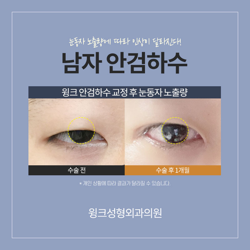 남자안검하수 또렷하게 교정하여 시원한 인상으로 개선하는 방법 관련 이미지 3