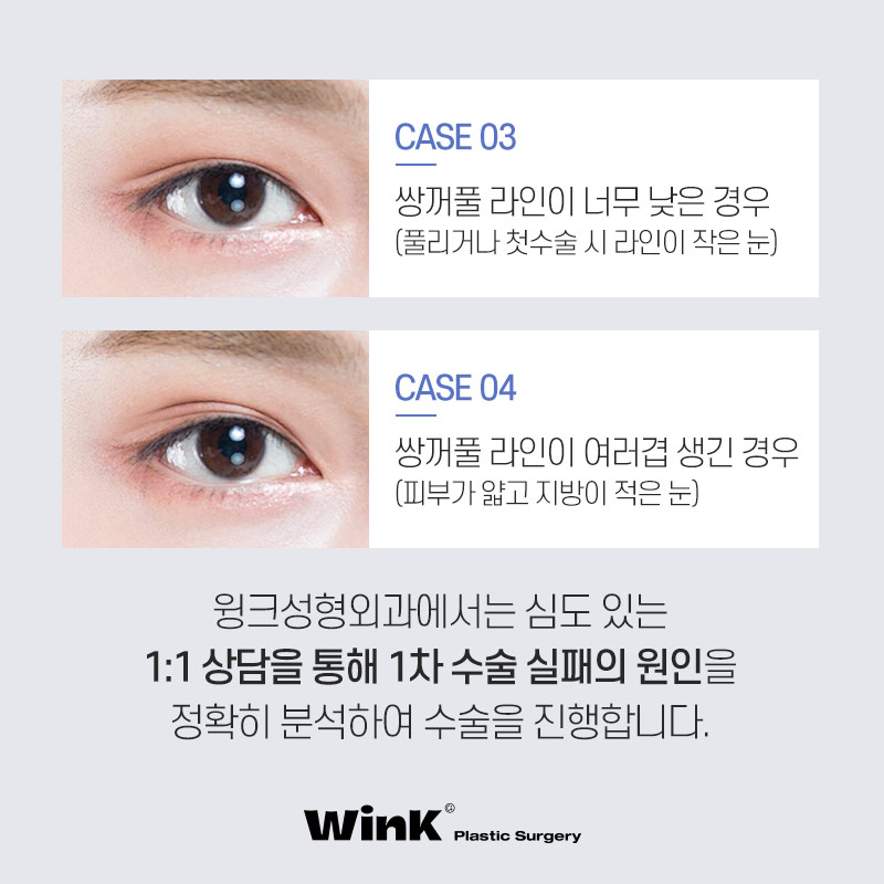 마지막 눈재수술을 위한 선택! 윙크성형외과 눈재수술 관련 이미지 4