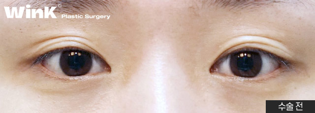 Wink canthoplasty and lower canthoplasty to overcome a cramped-looking eye shape! image 3