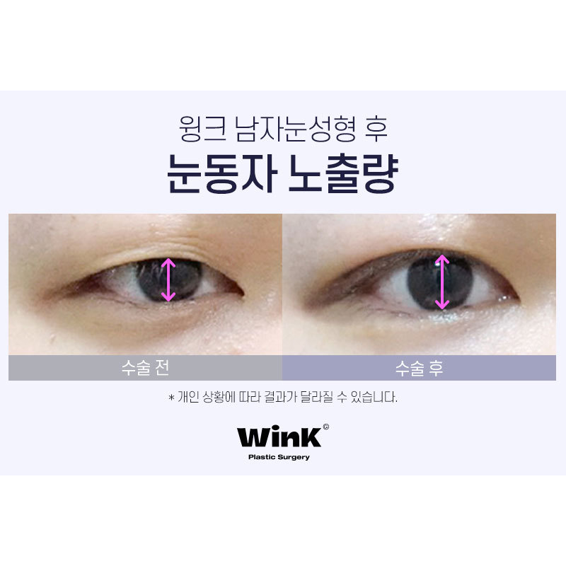 Men’s Eye Surgery: Won’t It Feel Too Much? With WINK Plastic Surgery, for a Natural and Defined Line! image 4