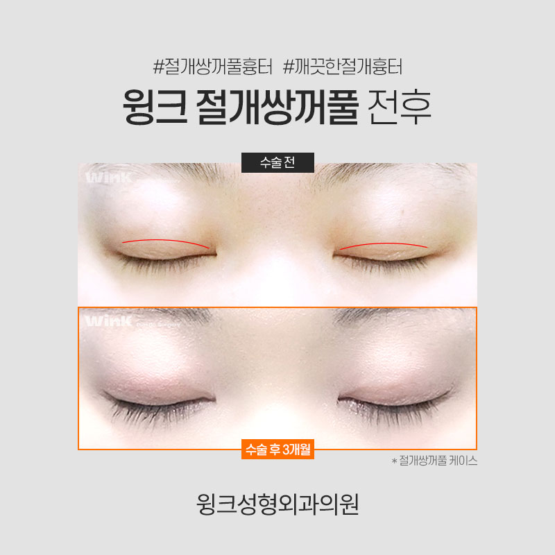 쌍꺼풀 깊은 고정 풀기 관련 이미지 6