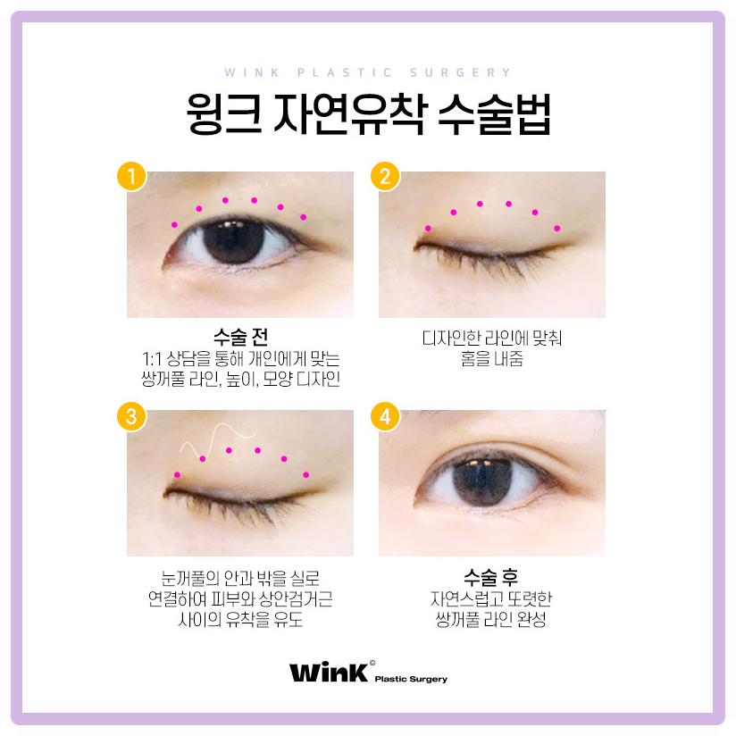 자연유착쌍꺼풀후기 자연유착법 윙크성형외과 자연유착쌍꺼풀비용 관련 이미지 2