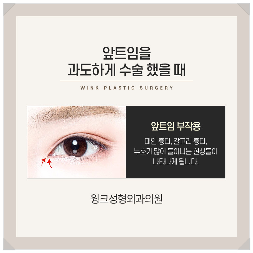 Recovery Period After Epicanthoplasty Restoration, Epicanthoplasty Scar, If You’re Only Looking Into Epicanthoplasty, Wink Plastic Surgery image 3
