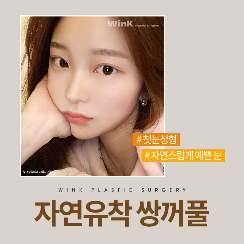 자연유착쌍수후기 자연유착전후를 알아본다면 윙크성형외과가 정답! 관련 이미지 1