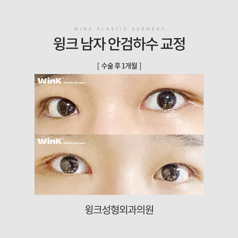 남자 안검하수 교정에 관해 알아보겠습니다. 관련 이미지 6