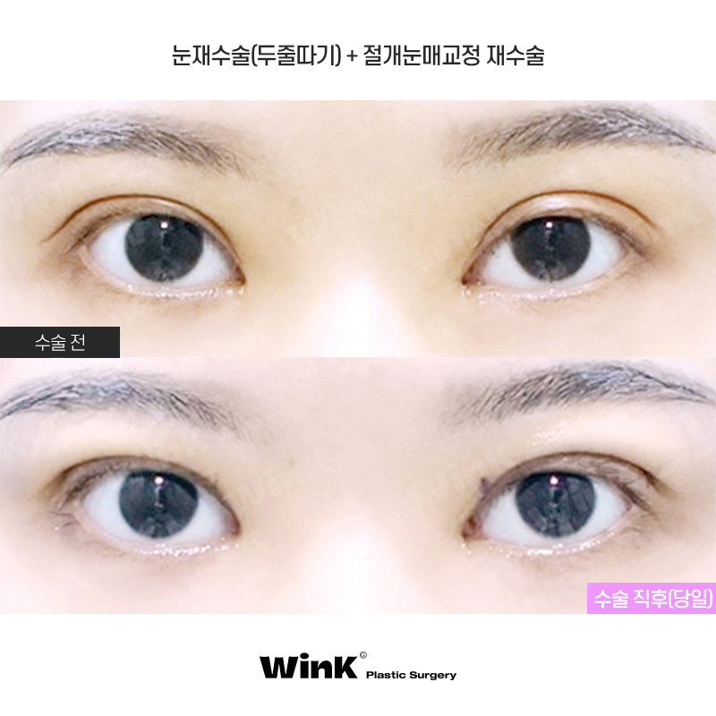 높고 깊은 고정으로 생긴 소세지눈, 윙크성형외과 두줄따기로 라인낮추기! 관련 이미지 1